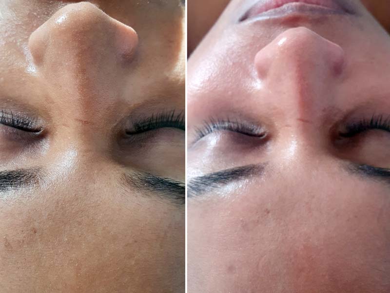 Hydrafacial Behandlung bei NiceFeet & Facial in Balingen. Poren Reinigung. Vorher - Nachher Effekt