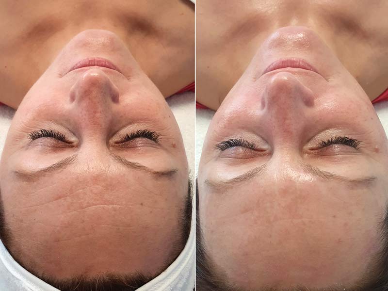 Hydrafacial Behandlung gegen Pigmentflecken in Balingen. Vorher - Nachher  Effekt