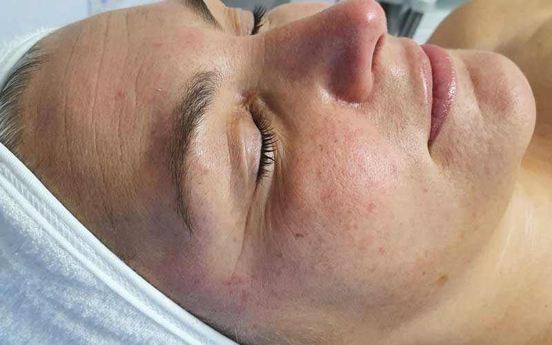 HydraFacial. Rosacea - Behandlung bei NiceFeet & Facial in Balingen. Vorher - Nachher Effekt